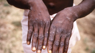 More than 700 monkeypox cases globally, 21 in US: CDC